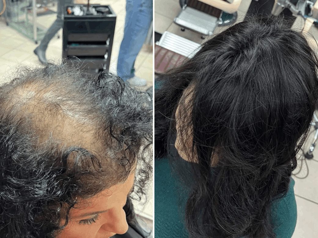 Soluzioni per calvizie e alopecia - *azione* *cosa* *dove*